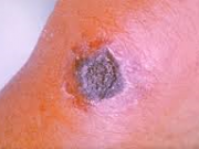 بیماری سیاه زخم / علائم و درمان سیاه زخم