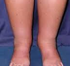 علل ورم پا و درمان آن