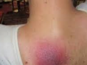 همه چیز درباره زخم بستر