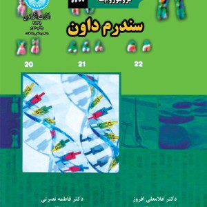 سندرم داون