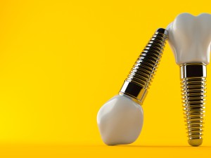 موفقیت اتصال پیچ زیرکونیایی به انواع ایمپلنت