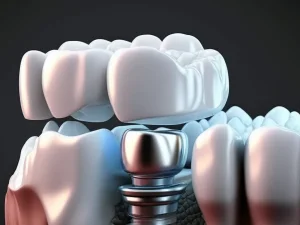 اصلاح سطحی انواع ایمپلنت تیتانیومی
