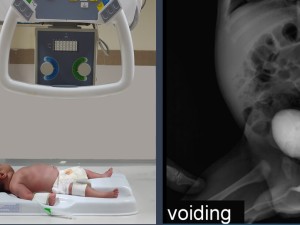 سیستویورتروگرام ادراری یا وی سی یو جی (VCUG) یکی از روش های تصویر برداری سیستم ادراری است. این روش که شامل چند مرحله عکس برداری از مثانه و سیستم ادراری است نیاز به فیکس ماندن کودک دارد که در بسیاری از مواقع این مهم براحتی اتفاق نمی افتد.