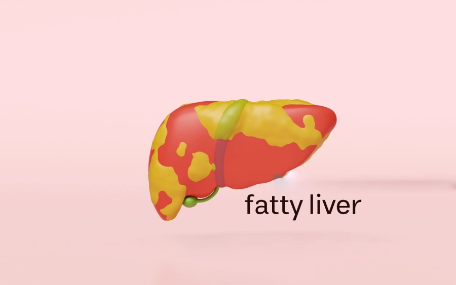 درمان کبد چرب