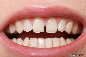 فاصله بین دندان ها و راههای بستن آن