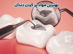 بهترین مواد پر کردن دندان