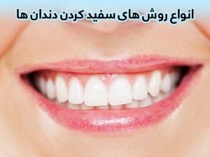 انواع روش سفید کردن دندان ها