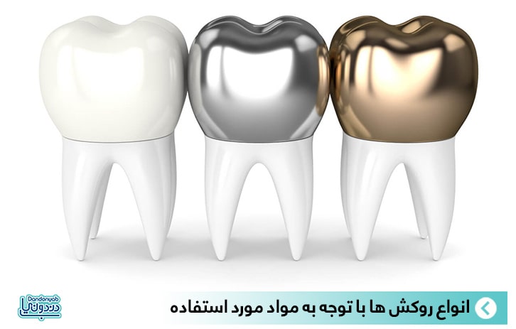 معایب روکش دندان تمام فلز