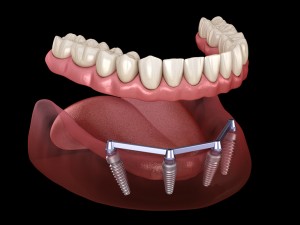 تحلیل استخوان مارژینال در جایگذاری ایمپلنت در اصفهان