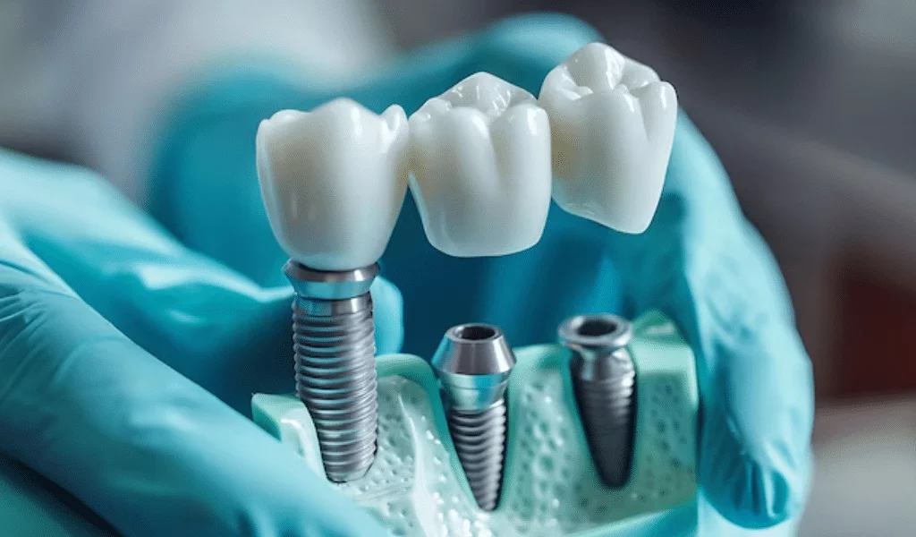 ایمپلنت دندان برای افراد دیابتی در اصفهان