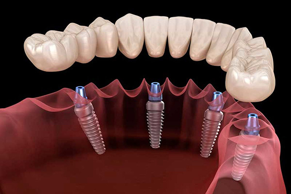 قیمت ایمپلنت دندان (2025 - 1404)