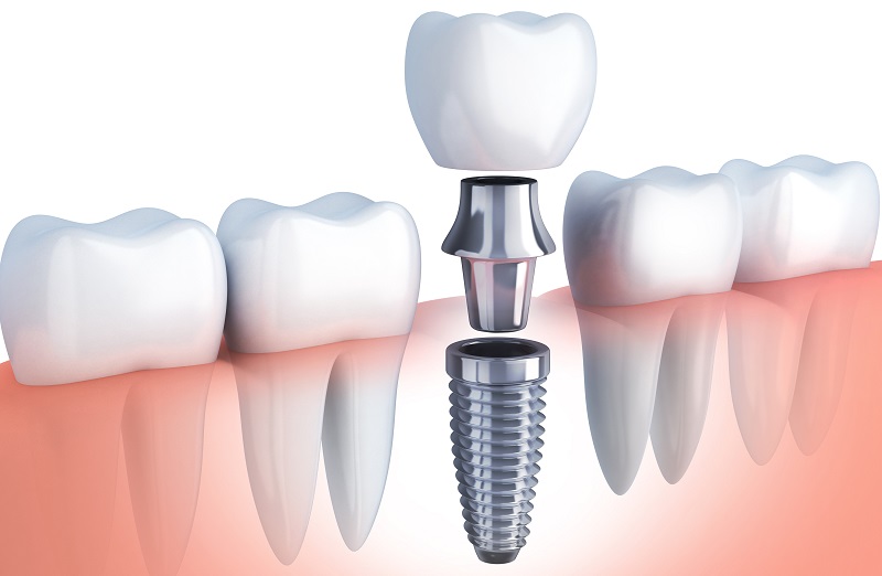 ایمپلنت دندان با بیهوشی