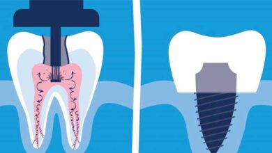 عصب کشی بهتر است یا ایمپلنت