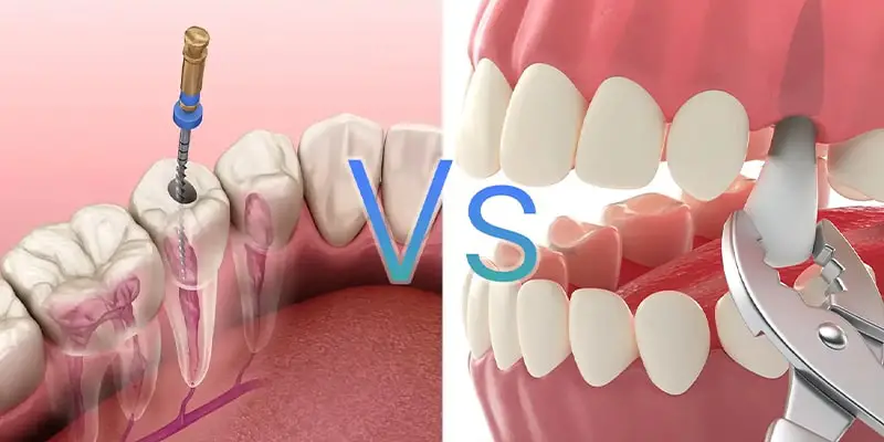 عصب کشی بهتر است یا کشیدن دندان