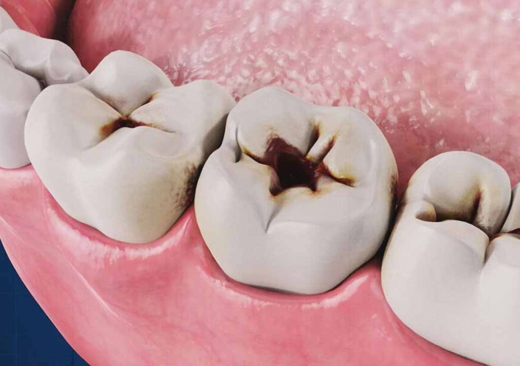 بهترین دکتر و متخصص درمان پوسیدگی دندان در اصفهان