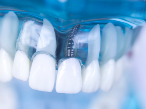 ایمپلنت تک دندان در اصفهان