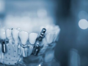 ایمپلنت دندان تکی در اصفهان