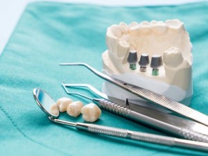 ایمپلنت دندان بدون جراحی در اصفهان