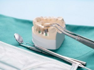 ایمپلنت دندان جلو در اصفهان