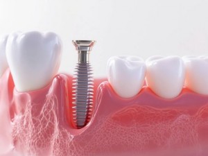 تغییرات سیتوکین در مایع شکافی لثه پس از گذاشتن براکت در اصفهان