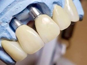 ایمپلنت دندان برای 46 (چهل و شش) ساله