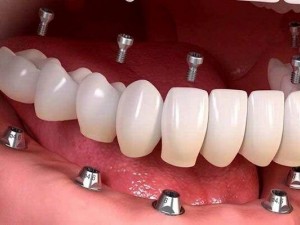 هزینه ایمپلنت دندان (1404) در اصفهان