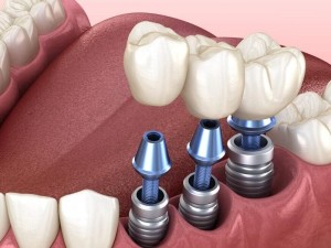 ایمپلنت دندان فک پایین در اصفهان