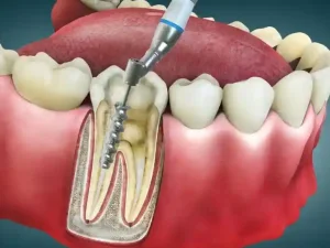 آیا عصب کشی دندان درد دارد