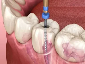 عصب کشی تک کانال