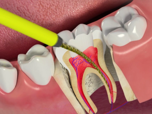 عصب کشی قسطی (اقساطی)