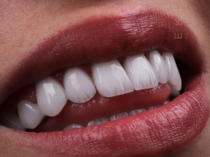 متخصص لمینت در اصفهان دکتر سمیرا احمدی محمدآبادی | لیست دندانپزشک لمینت اصفهان