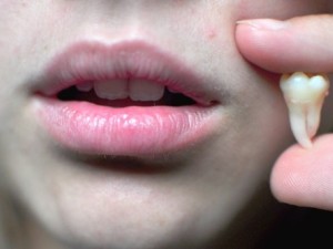 خدمات کشیدن دندان عقل در کاشان قمصر اصفهان