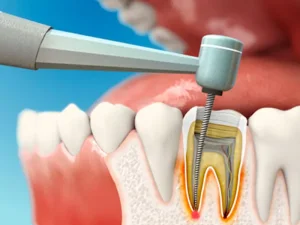 متخصص ریشه دندان در دلیجان اصفهان
