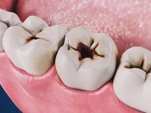 بهترین دکتر و متخصص درمان پوسیدگی دندان در اصفهان