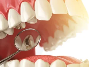 بهترین دکتر و متخصص درمان پوسیدگی دندان در پیربکران اصفهان