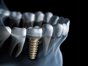 چند نوع ایمپلنت دندان داریم