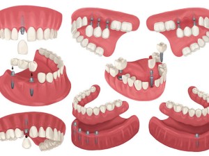 چگونگی عمل ایمپلنت دندان