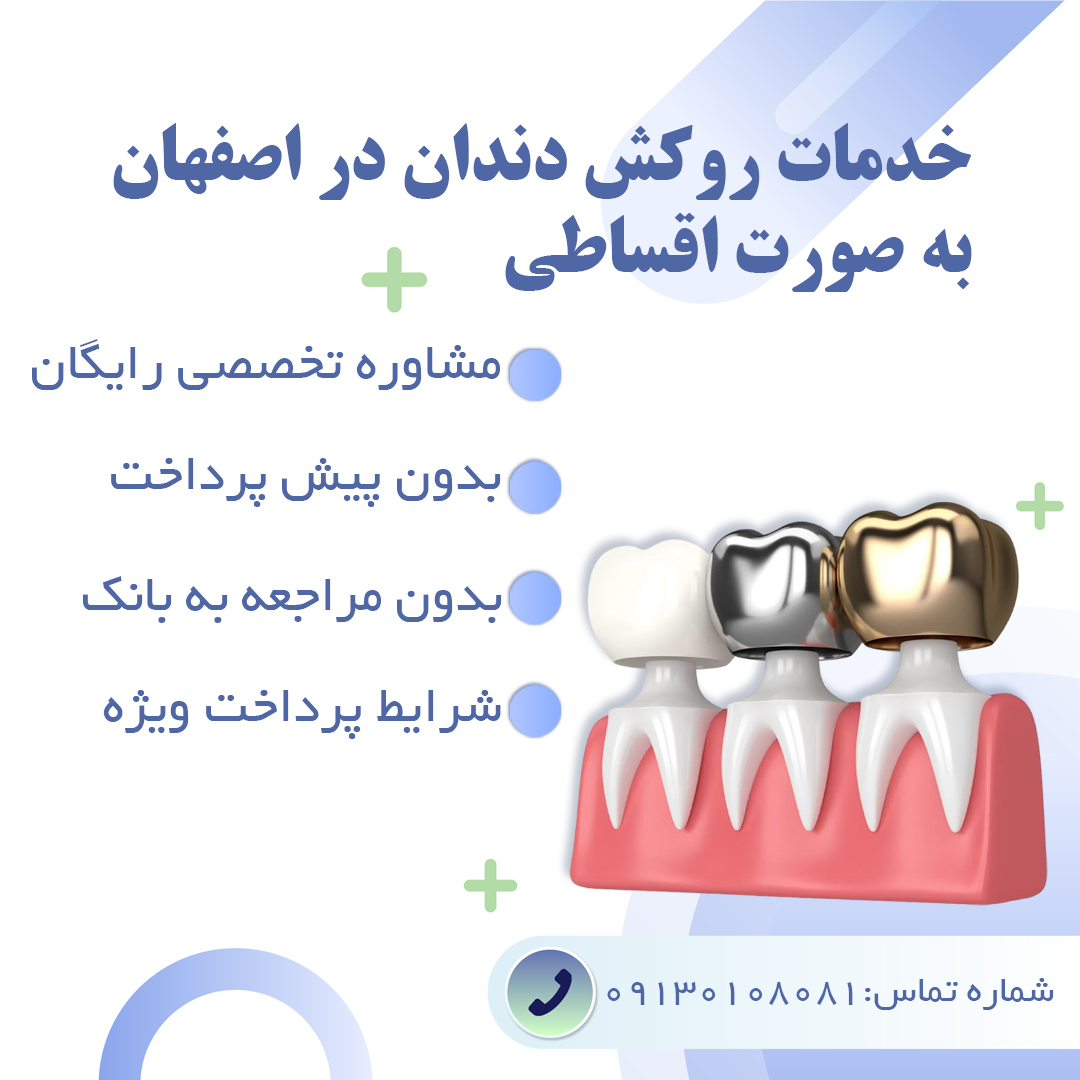 روکش دندان در اصفهان