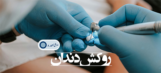 روکش دندان