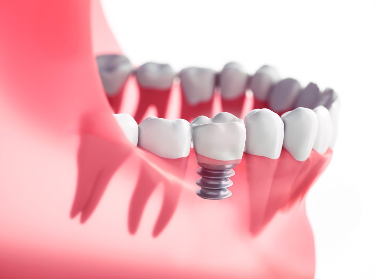 هزینه ایمپلنت دندان در اصفهان - دشتستان دنتال