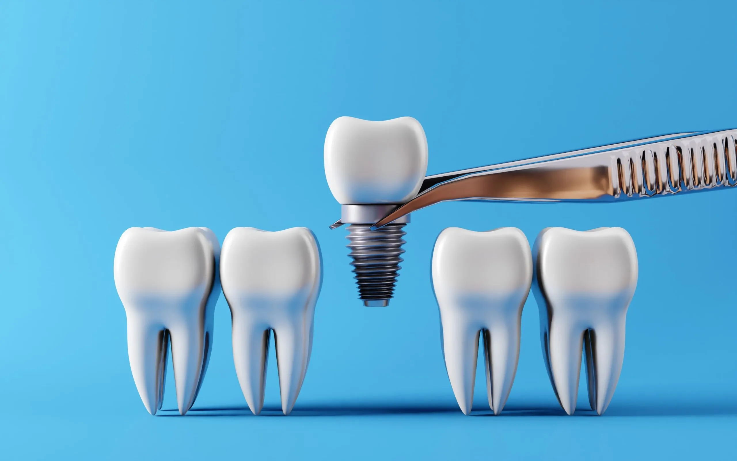 ایمپلنت اصفهان - دشتستان دنتال