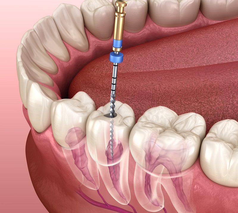 هزینه عصب کشی دندان 2025-1404 در اصفهان - کلینیک دندانپزشکی اصفهان