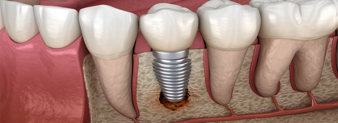 عوارض ایمپلنت دندان - کلینیک دندانپزشکی اصفهان