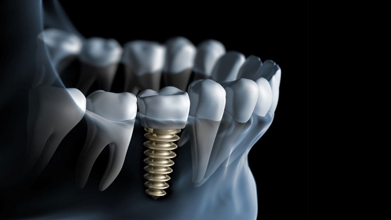 چند نوع ایمپلنت دندان داریم - کلینیک دندانپزشکی اصفهان