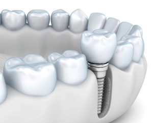 کلینیک دندانپزشکی اصفهان - قیمت ایمپلنت دندان در اصفهان (1404)