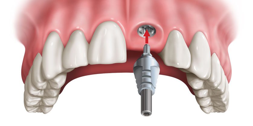 ایمپلنت دندان جلو - کلینیک دندانپزشکی اصفهان