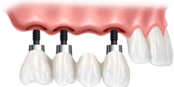 چگونگی عمل ایمپلنت دندان - کلینیک دندانپزشکی اصفهان
