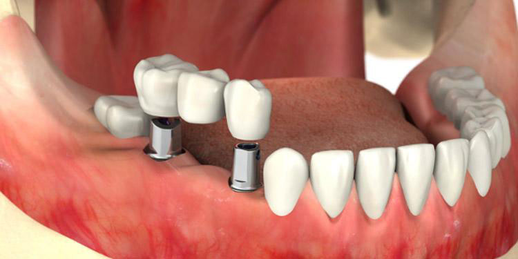 چگونگی عمل ایمپلنت دندان - کلینیک دندانپزشکی اصفهان