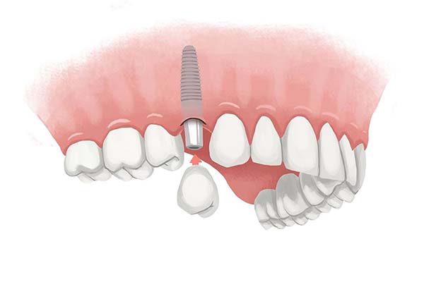 ایمپلنت دندان چیست و چگونه است - کلینیک دندانپزشکی اصفهان