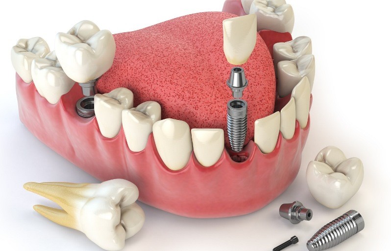 ایمپلنت دندان چیست و چگونه است - کلینیک دندانپزشکی اصفهان